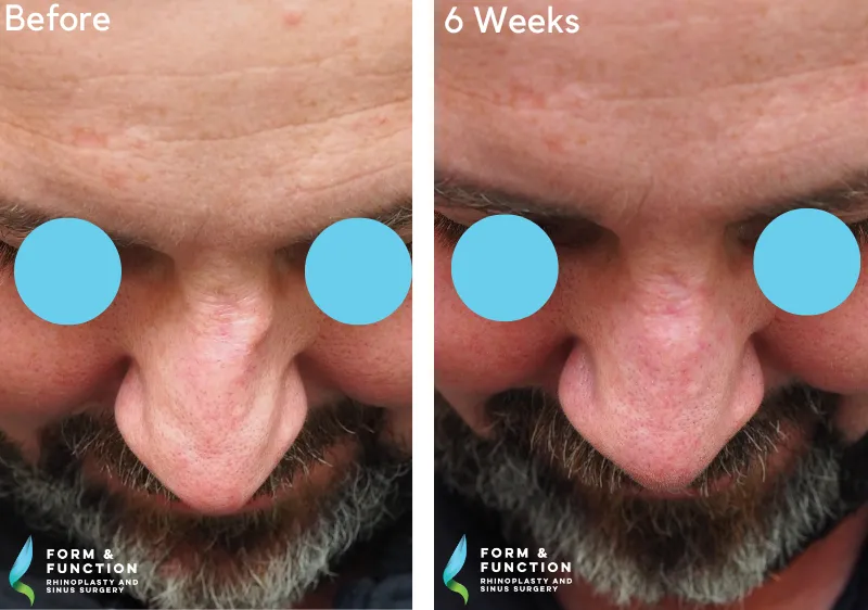 Before and after, 6 weeks after rhinoplasty (photograph 2 of 4)