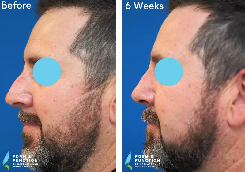 Before and after, 6 weeks after rhinoplasty (photograph 3 of 4)