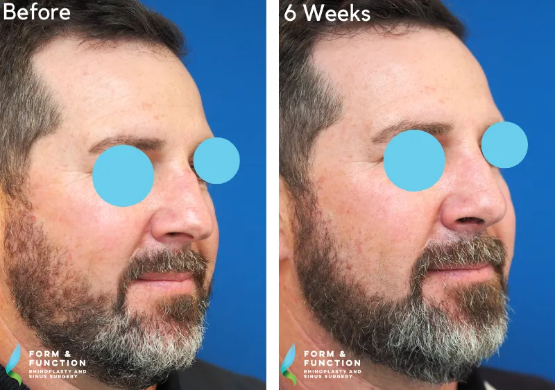 Before and after, 6 weeks after rhinoplasty (photograph 4 of 4)