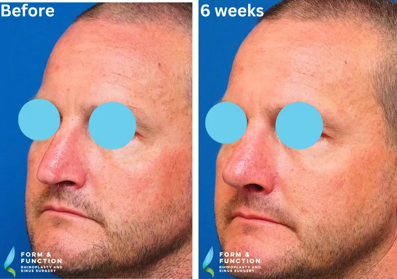 Before and after, 6 weeks after rhinoplasty (photograph 1 of 4)