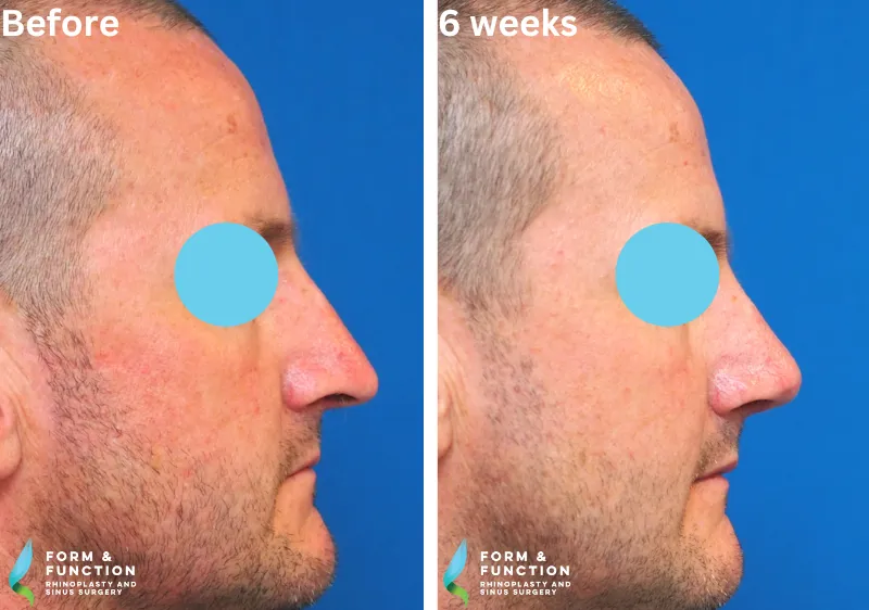 Before and after, 6 weeks after rhinoplasty (photograph 2 of 4)