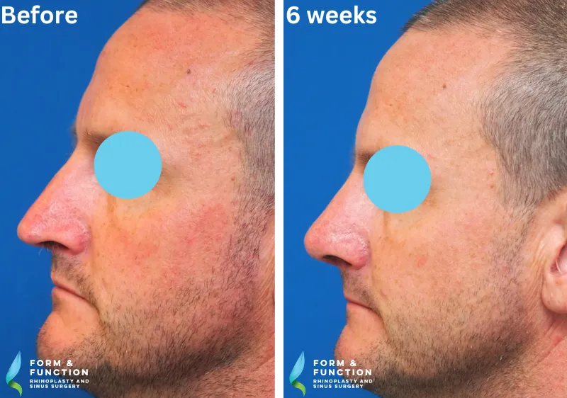 Before and after, 6 weeks after rhinoplasty (photograph 4 of 4)