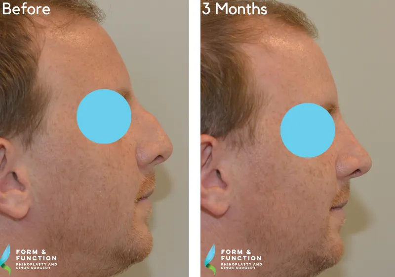 Before and after, 3 months after rhinoplasty (photograph 1 of 4)