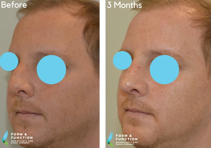 Before and after, 3 months after rhinoplasty (photograph 2 of 4)
