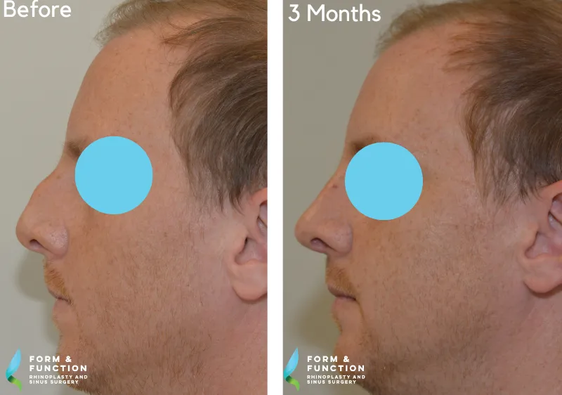 Before and after, 3 months after rhinoplasty (photograph 3 of 4)