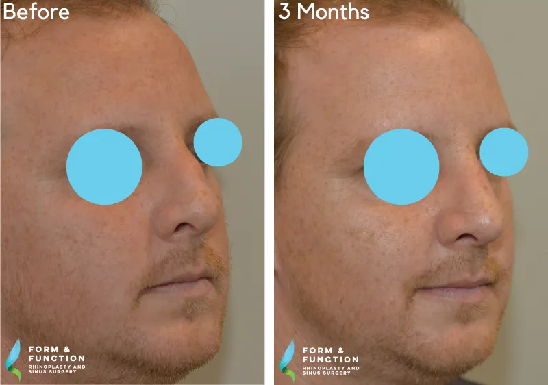 Before and after, 3 months after rhinoplasty (photograph 4 of 4)