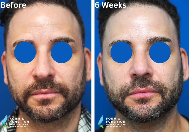 Before and after, 6 weeks after rhinoplasty (photograph 1 of 4)