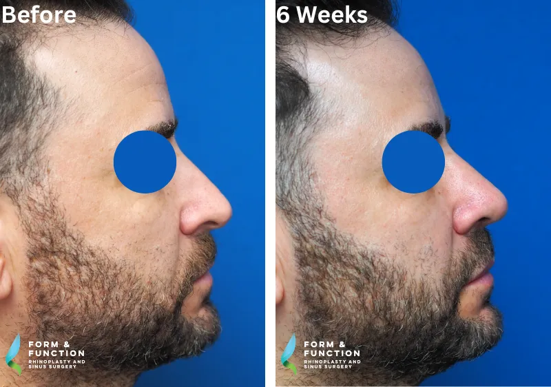 Before and after, 6 weeks after rhinoplasty (photograph 2 of 4)