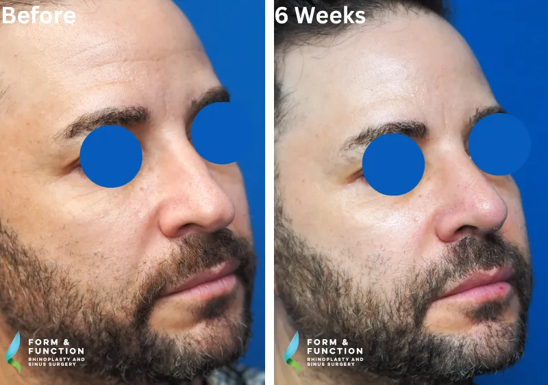 Before and after, 6 weeks after rhinoplasty (photograph 3 of 4)