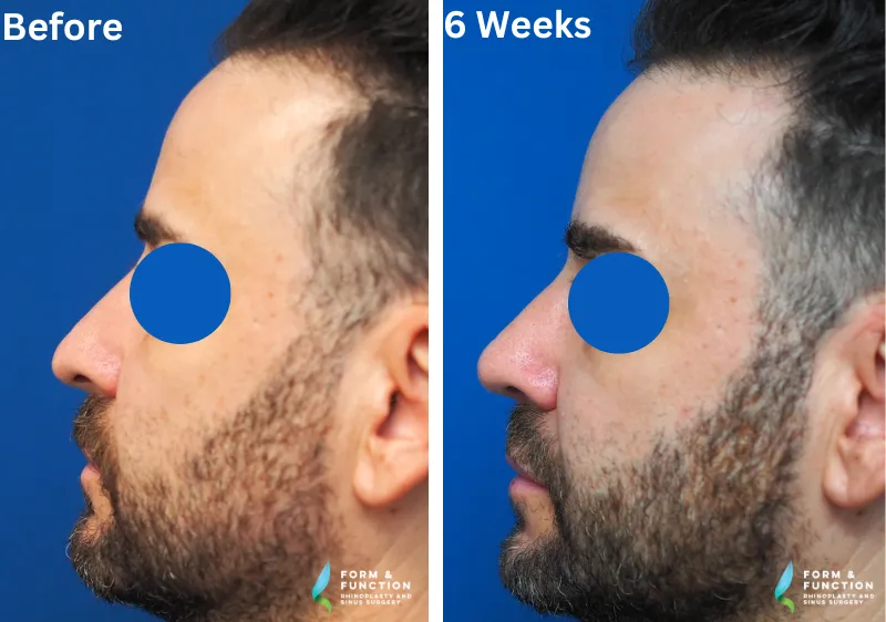 Before and after, 6 weeks after rhinoplasty (photograph 4 of 4)
