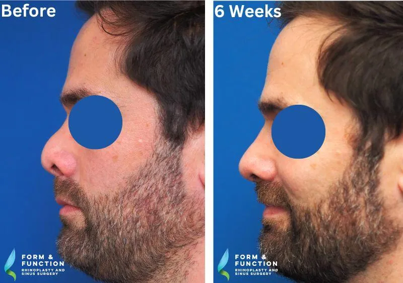 Before and after, 6 weeks after rhinoplasty (photograph 1 of 3)