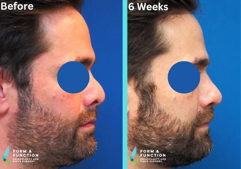 Before and after, 6 weeks after rhinoplasty (photograph 2 of 3)