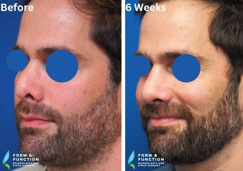 Before and after, 6 weeks after rhinoplasty (photograph 3 of 3)