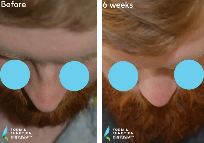 Before and after, 6 weeks after rhinoplasty (photograph 1 of 3)