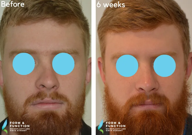 Before and after, 6 weeks after rhinoplasty (photograph 2 of 3)