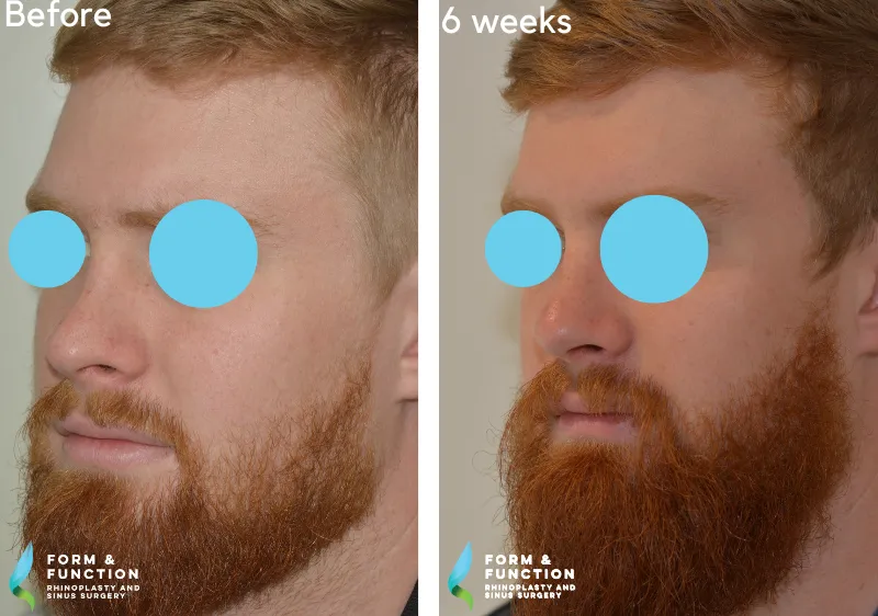 Before and after, 6 weeks after rhinoplasty (photograph 3 of 3)