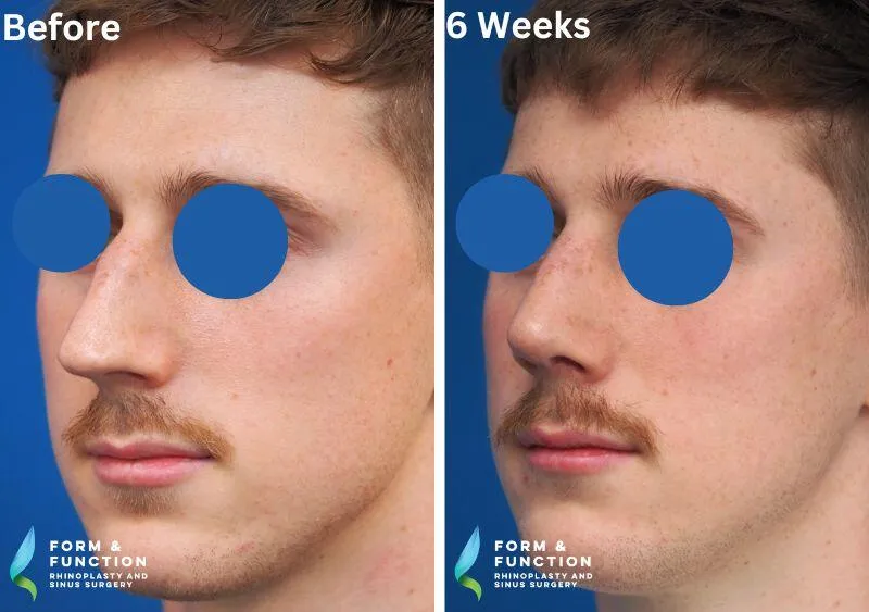 Before and after, 6 weeks after rhinoplasty (photograph 1 of 4)
