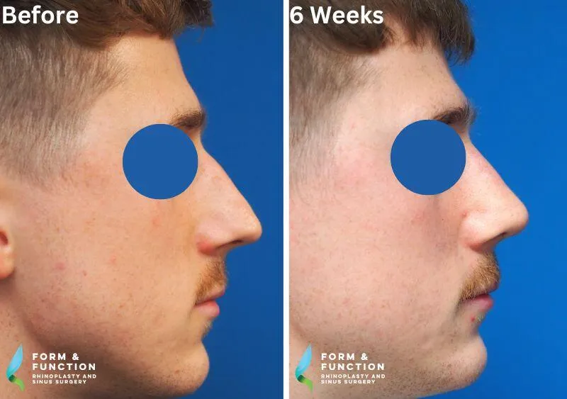 Before and after, 6 weeks after rhinoplasty (photograph 2 of 4)