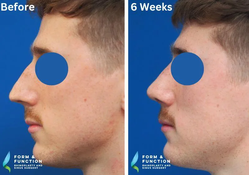 Before and after, 6 weeks after rhinoplasty (photograph 3 of 4)