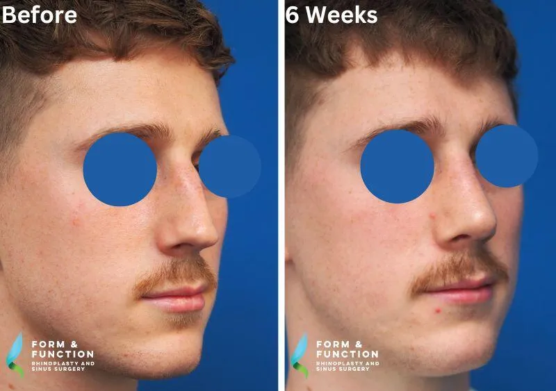 Before and after, 6 weeks after rhinoplasty (photograph 4 of 4)