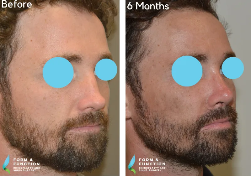 Before and after, 6 months after rhinoplasty (photograph 1 of 4)
