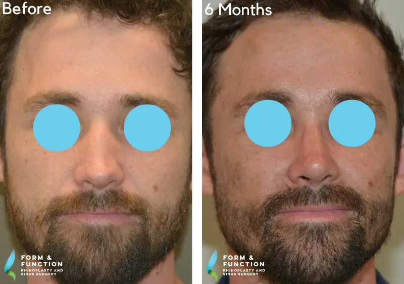 Before and after, 6 months after rhinoplasty (photograph 2 of 4)