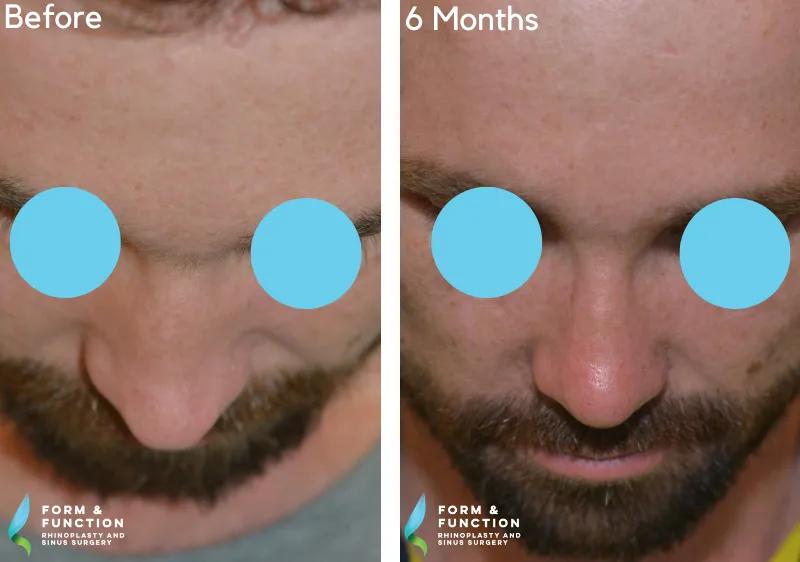 Before and after, 6 months after rhinoplasty (photograph 3 of 4)