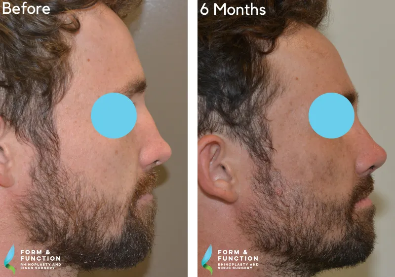 Before and after, 6 months after rhinoplasty (photograph 4 of 4)