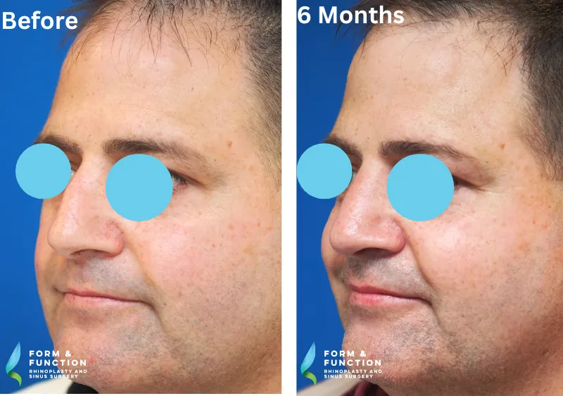 Before and after, 6 months after rhinoplasty (photograph 1 of 4)