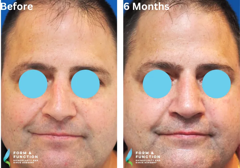 Before and after, 6 months after rhinoplasty (photograph 2 of 4)