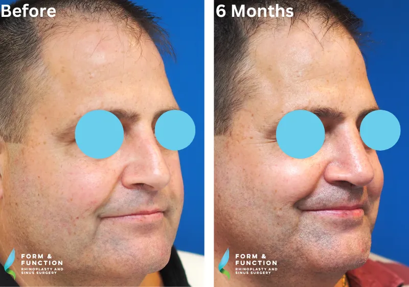 Before and after, 6 months after rhinoplasty (photograph 3 of 4)