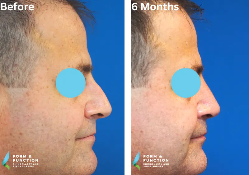Before and after, 6 months after rhinoplasty (photograph 4 of 4)